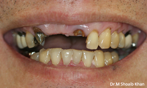 before dental arlington heights dentist
