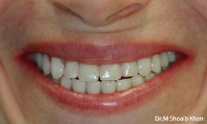 dental arlington heights after