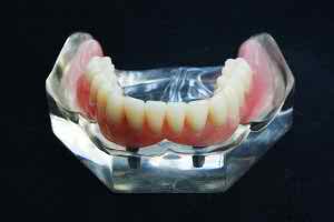 Complete Dentures