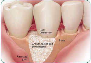 bone graft