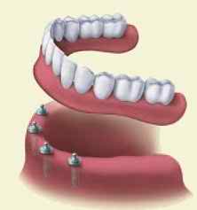denture stabilization