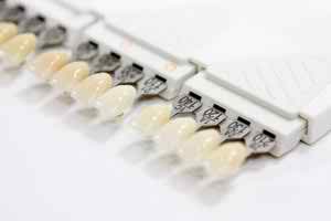 veneers