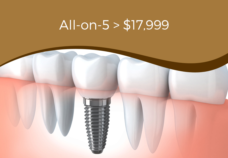 all on five dental implants arlington heights dentist