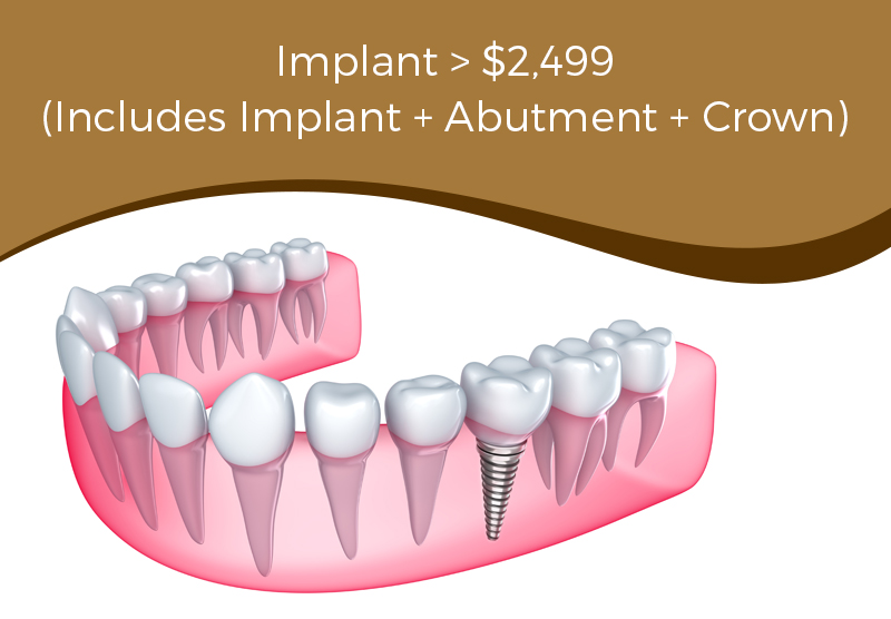 implants special arlington