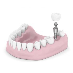 dental implants