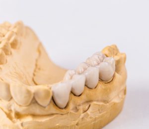 about dental bridges