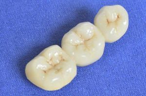 teeth prosthetics dentist arlington heights