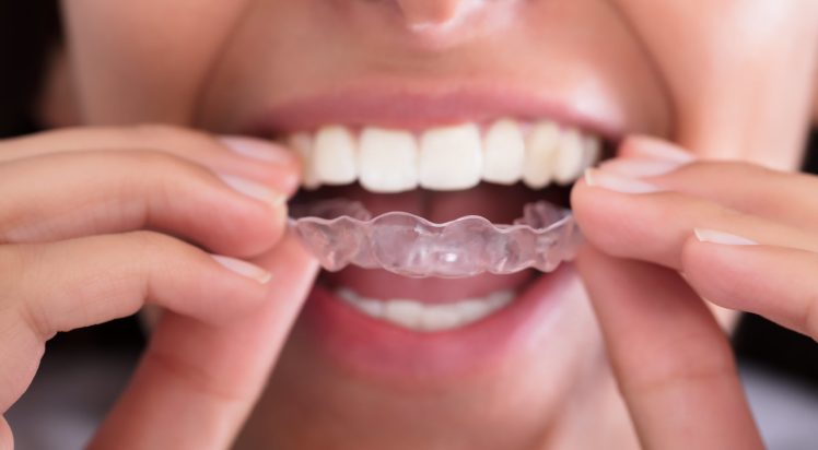invisalign